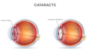 Diagram of cataracts