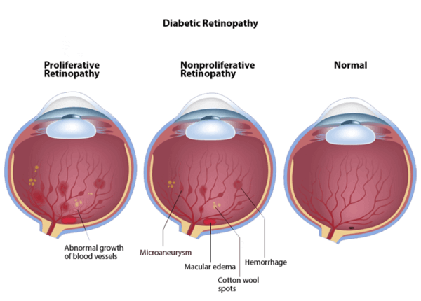 Diabetic Retinopathy in Mount Vernon, & Sedro Woolley