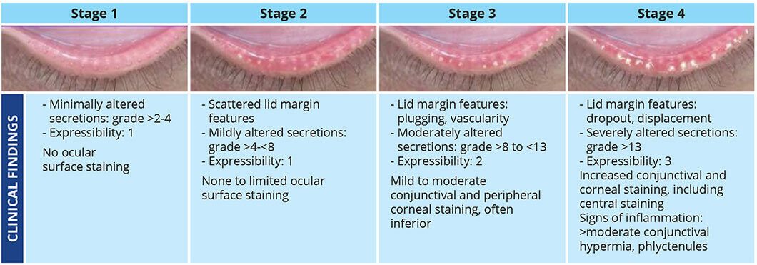 iLux Dry Eye Treatment Mount Vernon, Whidbey, Stanwood & Sedro Woolley